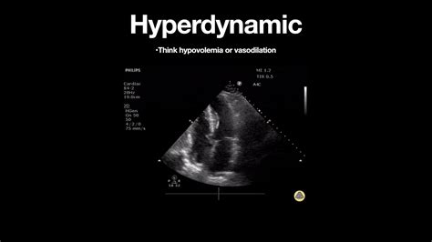 hyperdynamic lv systolic function|hyperdynamic left ventricle symptoms.